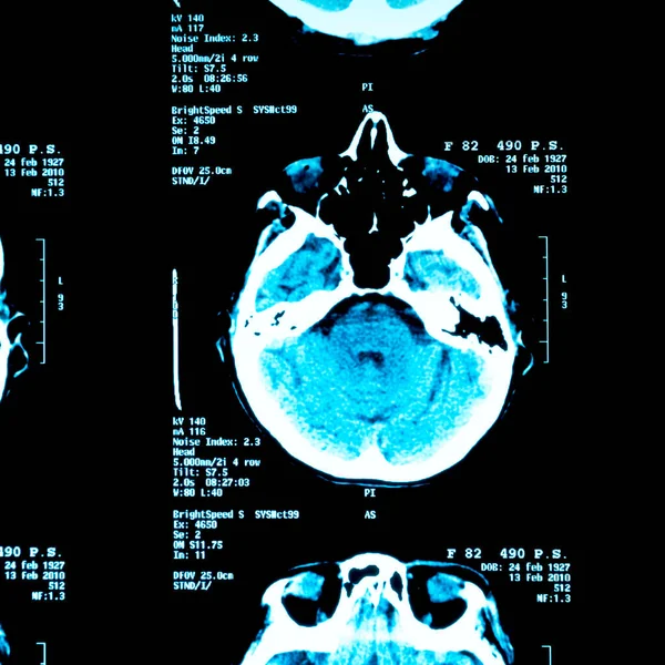 Brain Rays Adult Person — Stock Photo, Image