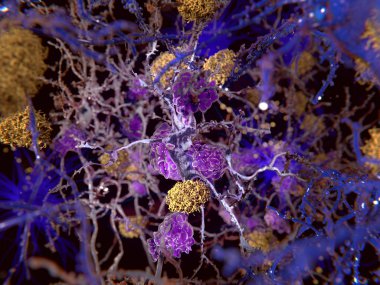 3D bilgisayar Illustration Alzheimer hastalığı. Amiloid plaklar nöronlar zarar sarı yapılardır. Menekşe hücreleri bu hücre microglia hücrelerdir ve hasta nöronlar bozulmasına yol açar.