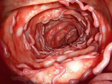 Kolon ülseratif kolit tarafından etkilenen, büyük pseudopolyps ile, 3D rendering. Bu insan bağırsak inflamatuar bir hastalıktır. Pseudopolyps neoplastik değil, inlammatat doku