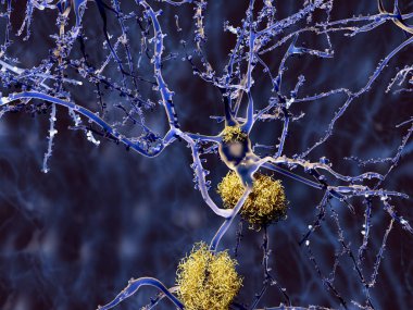 Alzheimer disease: neuron with amyloid plaques, illustration clipart