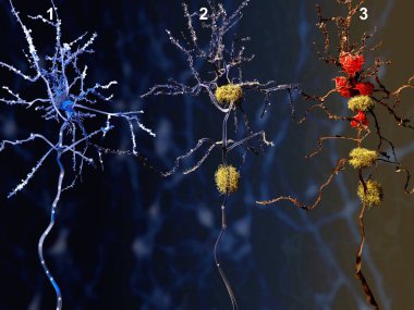 Alzheimer hastalığının 3 aşaması. 1. sağlıklı nöron. 2. amiloid plaklar (sarı) ile nöron. 3. ölü nöron mikroglia hücreleri tarafından sindirilmiş olmak (kırmızı). Illüstrasyon 