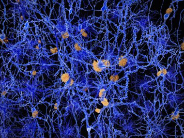 Alzheimer hastalığı, nöron ağı amiloid plaklar ile. İllüstrasyon