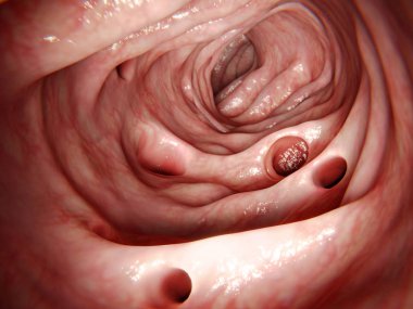 Diverticulitis. 3d rendering. Diverticula in the large intestine. Diverticulitis results of the inflammation of one of these diverticula. The most common sympton is abdominal pain. Illustration clipart