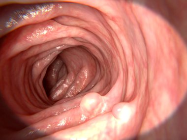 Adenomatours polip. 3D render. Kolon kanserine dönüşebilir bir polip. Böyle polipler önceden kanserli olarak kabul edilir. Hemen hemen tüm kolorektal tümörler adenomatous polip başlatın. İllüstrasyon