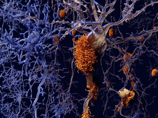 Alzheimer disease, neuron network with amyloid plaques. Illustration
