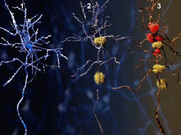 阿尔茨海默氏症的3个阶段 健康神经元 神经元与淀粉样斑块 被微胶质细胞 消化的死亡神经元 — 图库照片