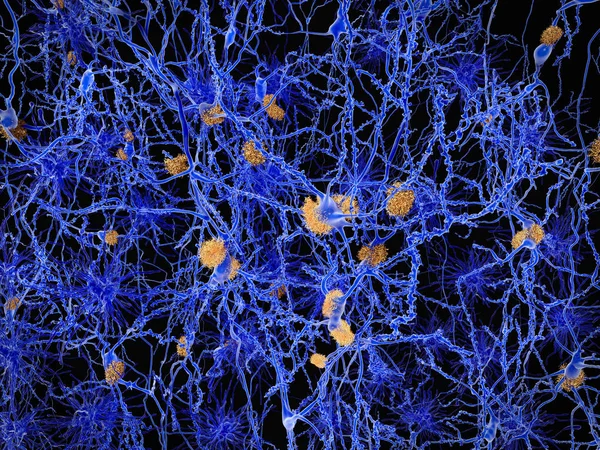 Enfermedad Alzheimer Red Neuronal Con Placas Amiloides Ilustración —  Fotos de Stock