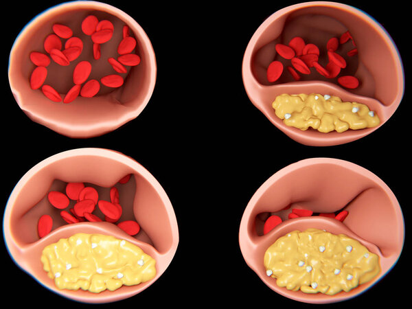 4 phases of Arteriosclerosis. Detailed scientific illustration