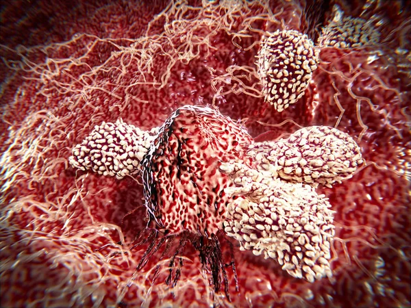 T lenfosit saldırı kanser hücresi; 3D-Rendering doğal katil hücreleri, kanser hücrelerini ve sitotokezik granül bırakan diğer değiştirilmiş hücreleri yok eden lenfositlerin bir türüdür. Illüstrasyon