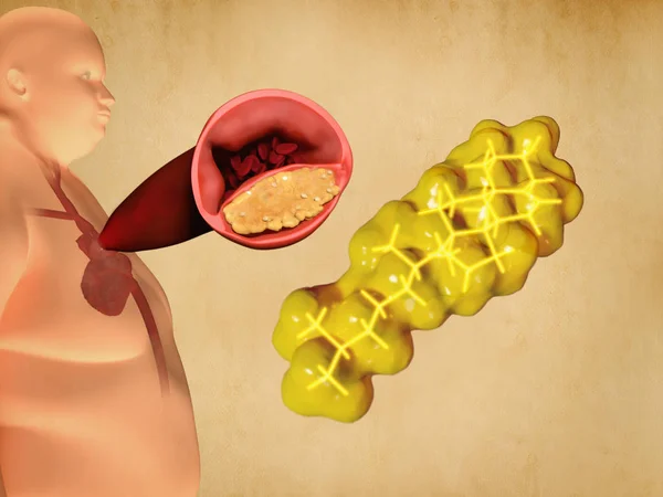 Cholesterolu Miażdżycy Szczegółowy Ilustracji — Zdjęcie stockowe