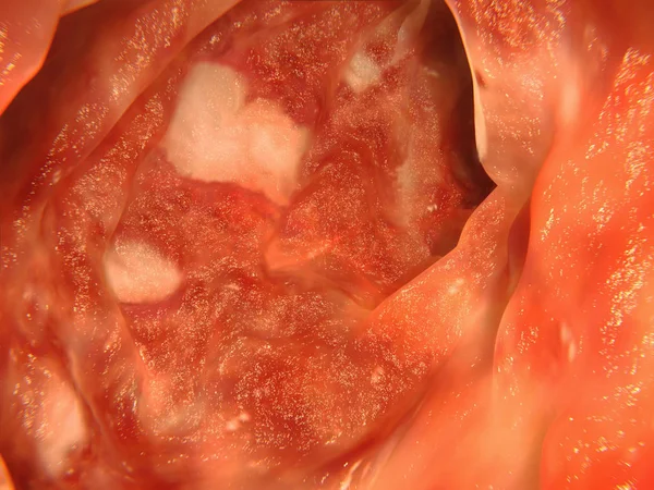 Vastagbél Colitis Ulcerosa Illusztráció — Stock Fotó