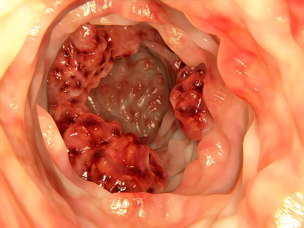 大腸がん詳細図 — ストック写真