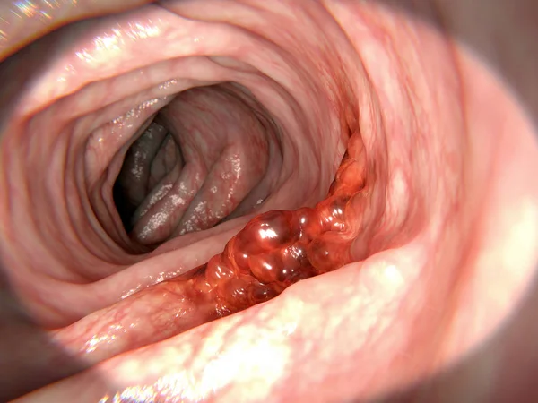 大腸がん レンダリング — ストック写真
