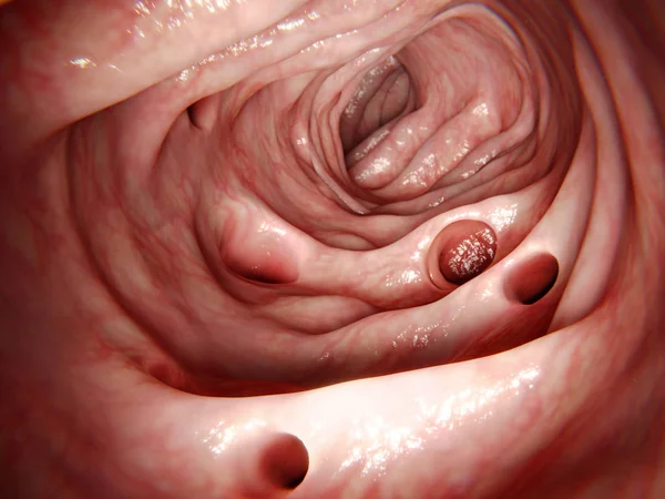 レンダリング 大腸に憩室 これらの憩室のいずれかの炎症の憩室炎の結果 最も一般的な Sympton 腹部の痛みです — ストック写真