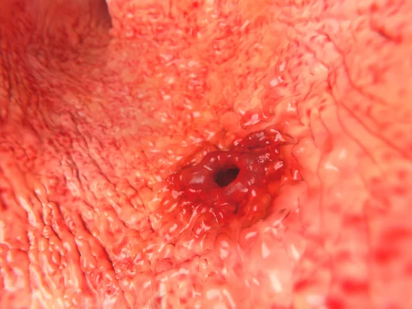 Úlcera Péptica Humana Ilustração — Fotografia de Stock