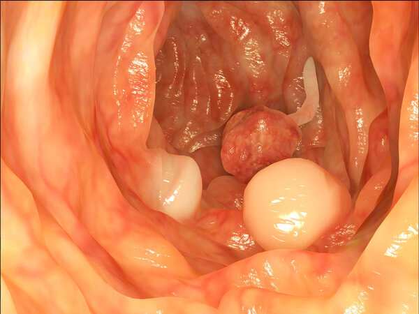 Human intestinal polyps. Illustration