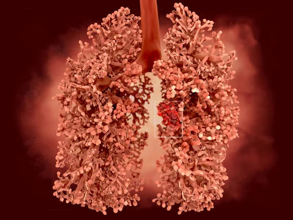 Cáncer Pulmonar Humano Ilustración — Foto de Stock