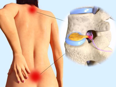 Omurilik disk herniasyonu. İllüstrasyon