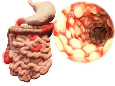 Intestine with Morbus Crohn. Illustration clipart