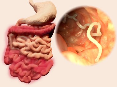 Tapeworm in human intestine. Illustration clipart
