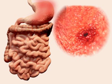 Gastrointestinal sistem içinde mide ulcera oluşumu. İllüstrasyon