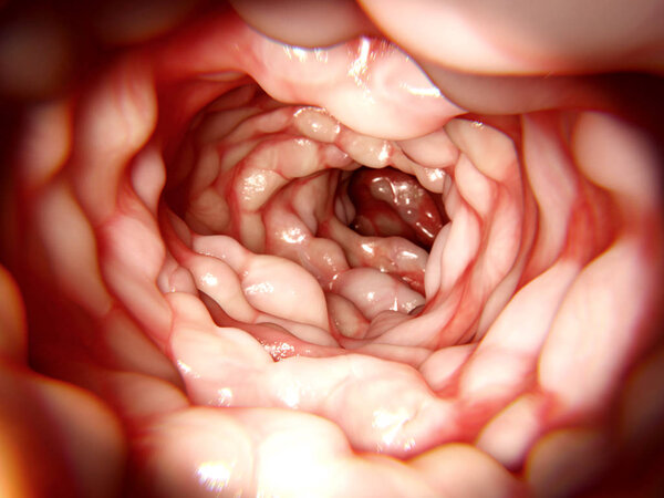 Intestine affected by Morbus Crohn. 3d rendering. Crohn's disease is an inflammatory bowel disease, it causes abdominal pain, diarrhea and vomiting. Illustration