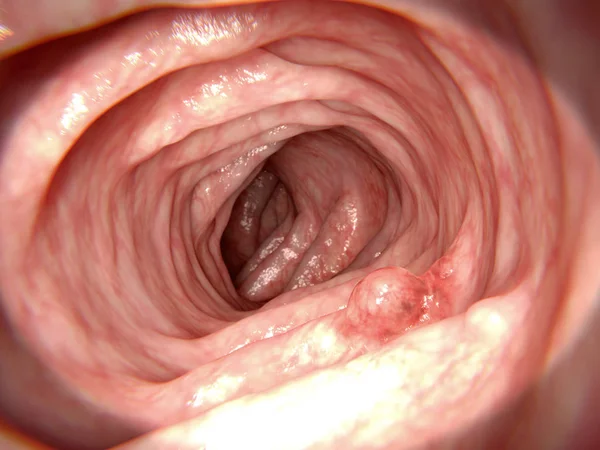 Adenomatours polip. 3D render. Kolon kanserine dönüşebilir bir polip. Böyle polipler önceden kanserli olarak kabul edilir. Hemen hemen tüm kolorektal tümörler adenomatous polip başlatın. İllüstrasyon