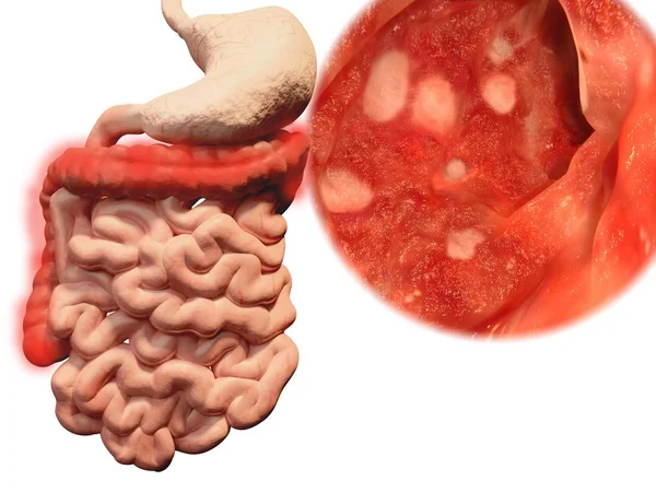 Ülseratif Kolit gastrointestinal sistem oluşumu. İllüstrasyon