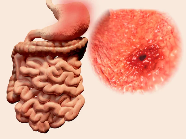Gastrointestinal Sistem Içinde Mide Ulcera Oluşumu Llüstrasyon — Stok fotoğraf