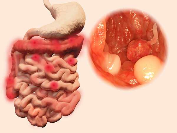 Polyps in the gastrointestinal tract. Illustration
