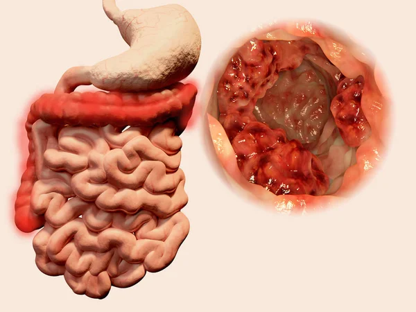 Gastrointestinal Sistem Içinde Malign Tümör Oluşumu Llüstrasyon — Stok fotoğraf