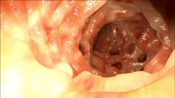 Rastreamento Câmera Disparado Através Intestino Humano Afetado Por Diverticulose — Vídeo de Stock