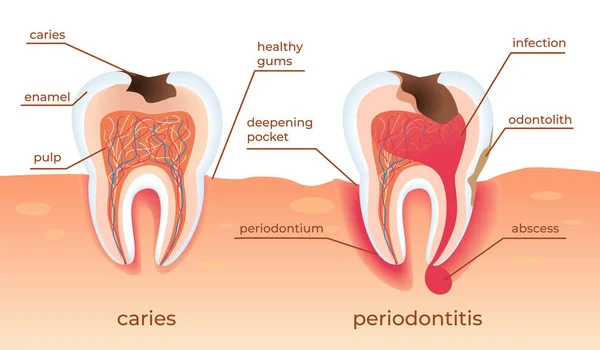 不健康的牙齿站在原始的牙龈。蛀牙. — 图库矢量图片