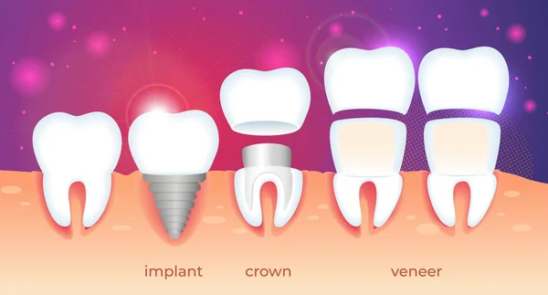 Ortodontik restorasyon. Implant, taç, kaplama.