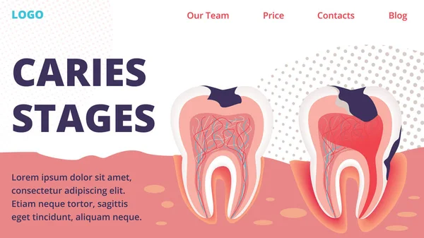 Caries Diferentes etapas Tratamiento Vector Sitio web — Vector de stock