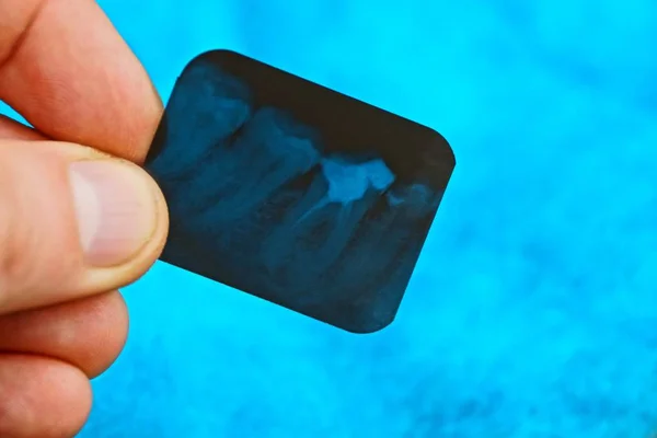 Маленький Черный Рентгеновский Снимок Зубов Пальцах Синем Фоне — стоковое фото