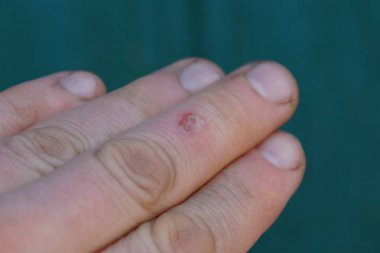 bir kırmızı küçük parmakları yara yanık