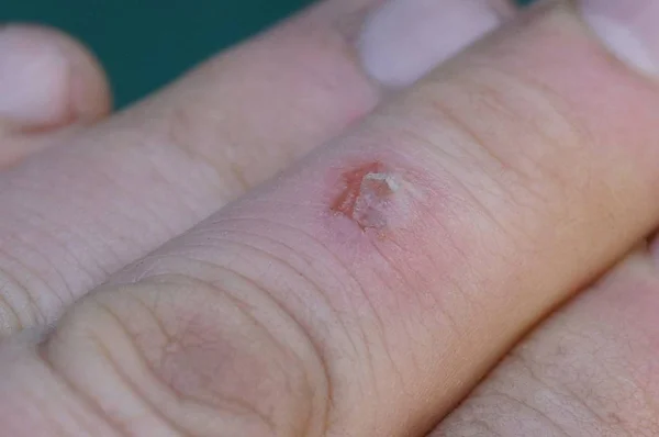 Одно Красное Маленькое Ожоговое Ранение Пальца Зеленом Фоне — стоковое фото