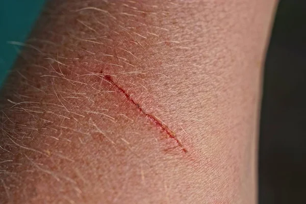 Scratched skin Stock Photos, Royalty Free Scratched skin Images ...