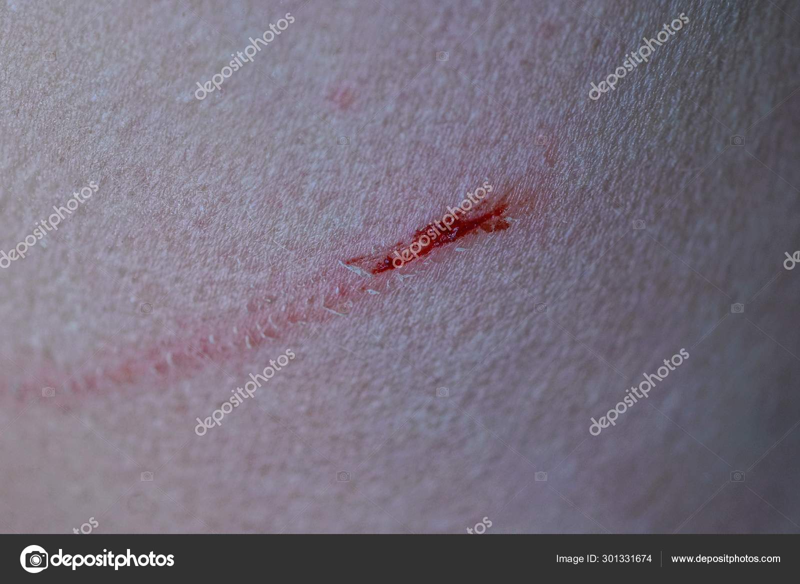 Red Scratch Cut Gray Skin Hand — Stock Photo © AnatolX #301331674