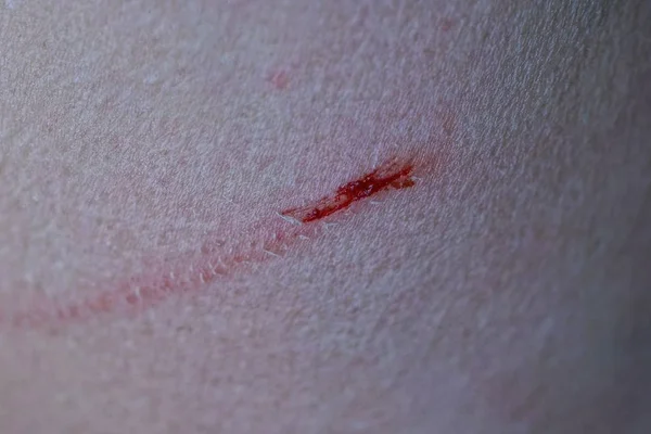 red  scratch cut on gray skin of hand