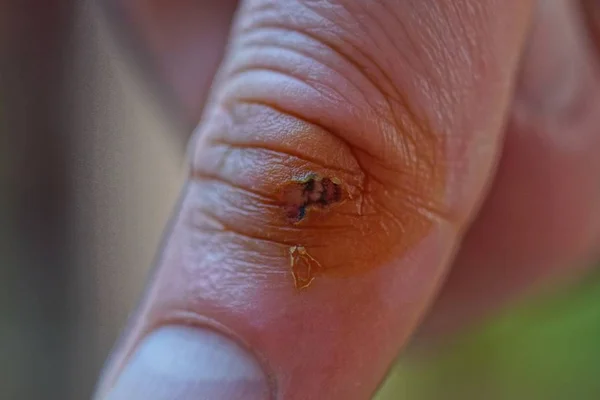 Een Grote Wond Grijze Huid Van Vinger — Stockfoto