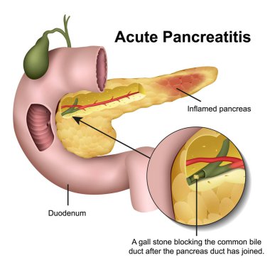 Acute pancreatitis 3d medical vector illustration on white background clipart