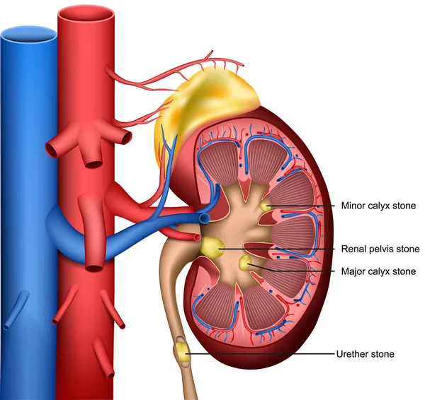 Πέτρες Στα Νεφρά Ιατρική Διάνυσμα Απεικόνιση Λευκό Φόντο — Διανυσματικό Αρχείο