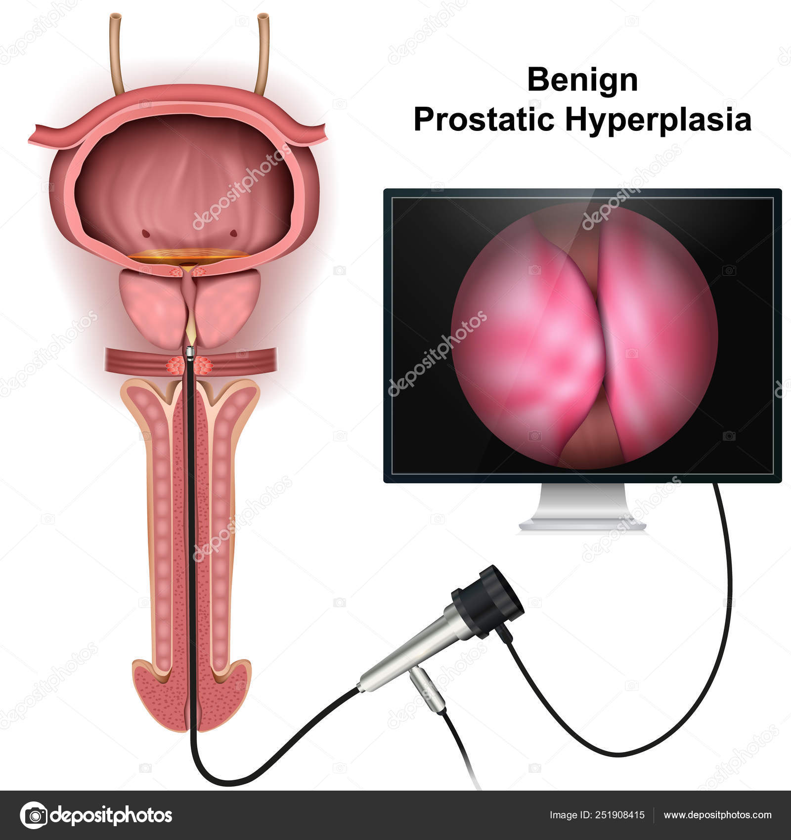test di iperplasia prostatica benigna