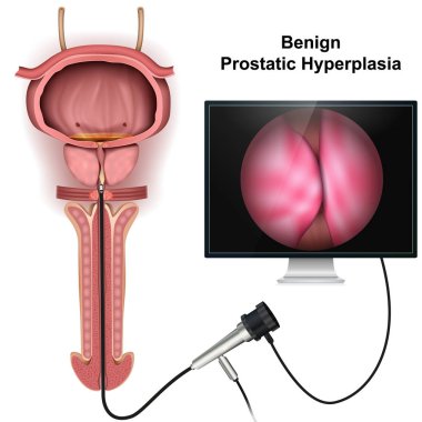 Benign prostatic hyperplasia 3d medical vector illustration on white background clipart