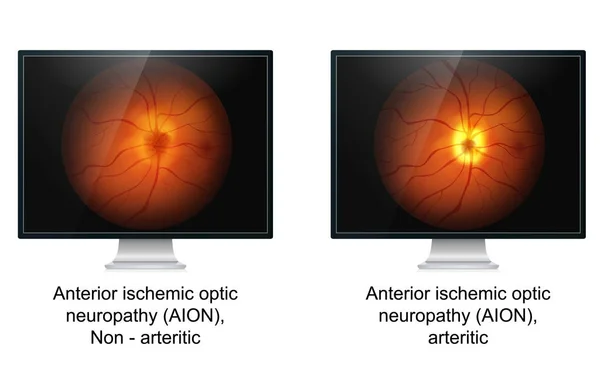 Оптична Ішемічна Нейропатія Медична Векторні Ілюстрації — стоковий вектор