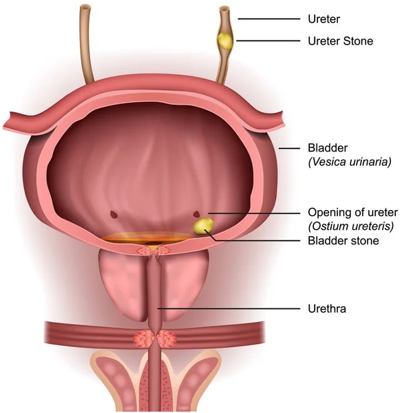 白の背景に膀胱結石3D 医療ベクトルイラスト — ストックベクタ