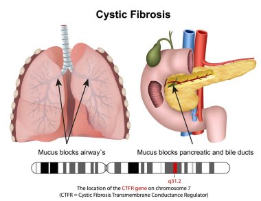 Açıklama ile cystric fibrozis 3d tıbbi vektör illüstrasyon
