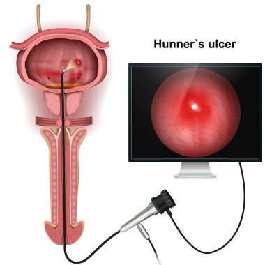 Hunner`s ulcer 3d medical vector illustration on white background clipart
